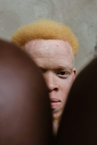 Close-up portrait of a man with albinism, highlighting unique facial features and blond hair.